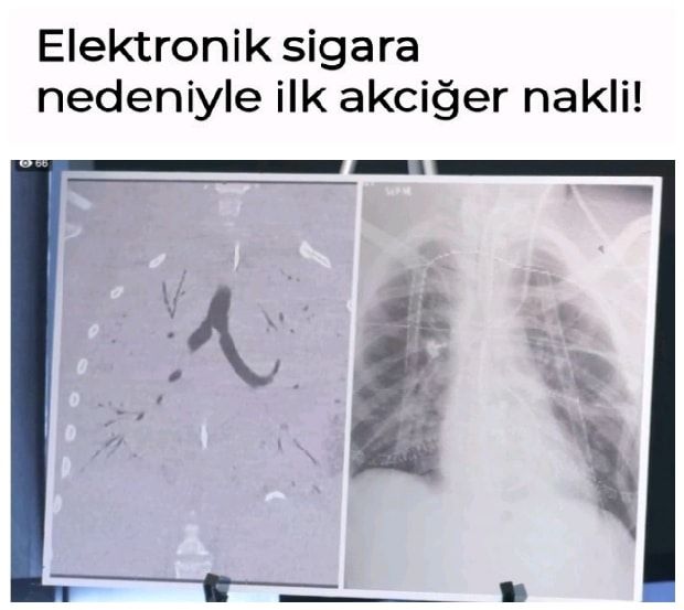 Elektronik sigara nedeniyle ilk akciğer nakli!